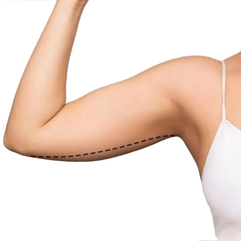 Arm Lift in Bangkok, Thailand by Wansiri Hospital — Plastic Surgery Procedure in Thailand