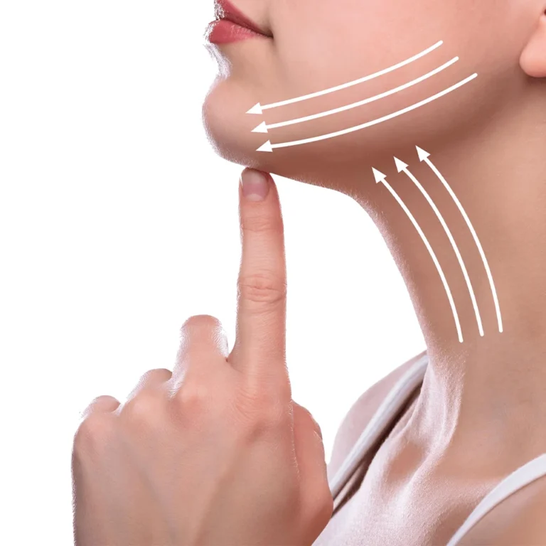 Neck Lift in Istanbul, Turkey by Dr. Gurkan Kayabasoglu