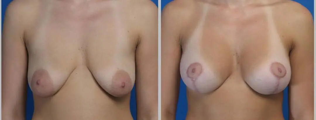 Breast Lift (Mastopexy) in Playa del Carmen, Mexico by CostaMed Medical Group — Procedure Gallery Photo