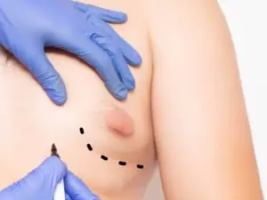 Gynecomastia in Istanbul, Turkey by Memorial Hospital — Plastic Surgery in Turkey