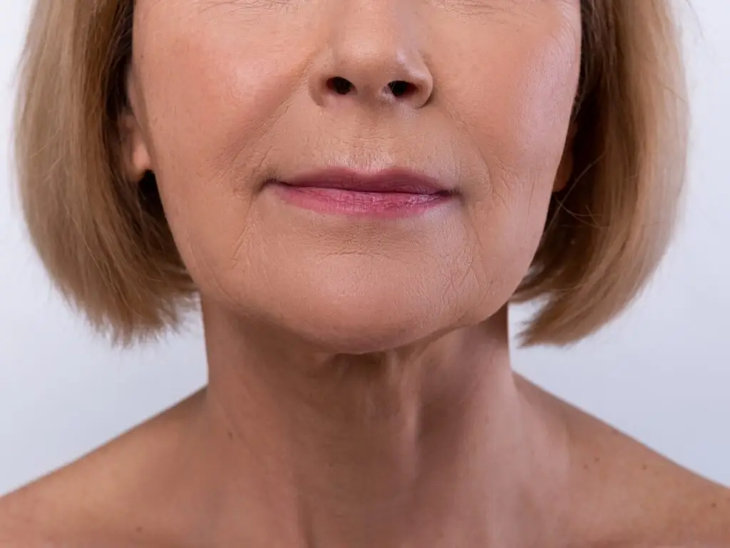Lip Lift in Istanbul, Turkey by Memorial Hospital — Plastic Surgery Procedure in Turkey