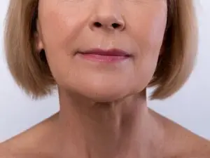 Lip Lift in Istanbul, Turkey by Memorial Hospital — Plastic Surgery in Turkey