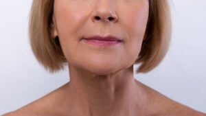 Lip Lift in Istanbul, Turkey by Memorial Hospital  at Memorial Hospital — Plastic Surgery Procedure Abroad