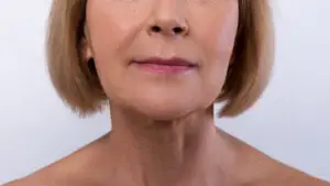 Lip Lift in Istanbul, Turkey by Memorial Hospital 