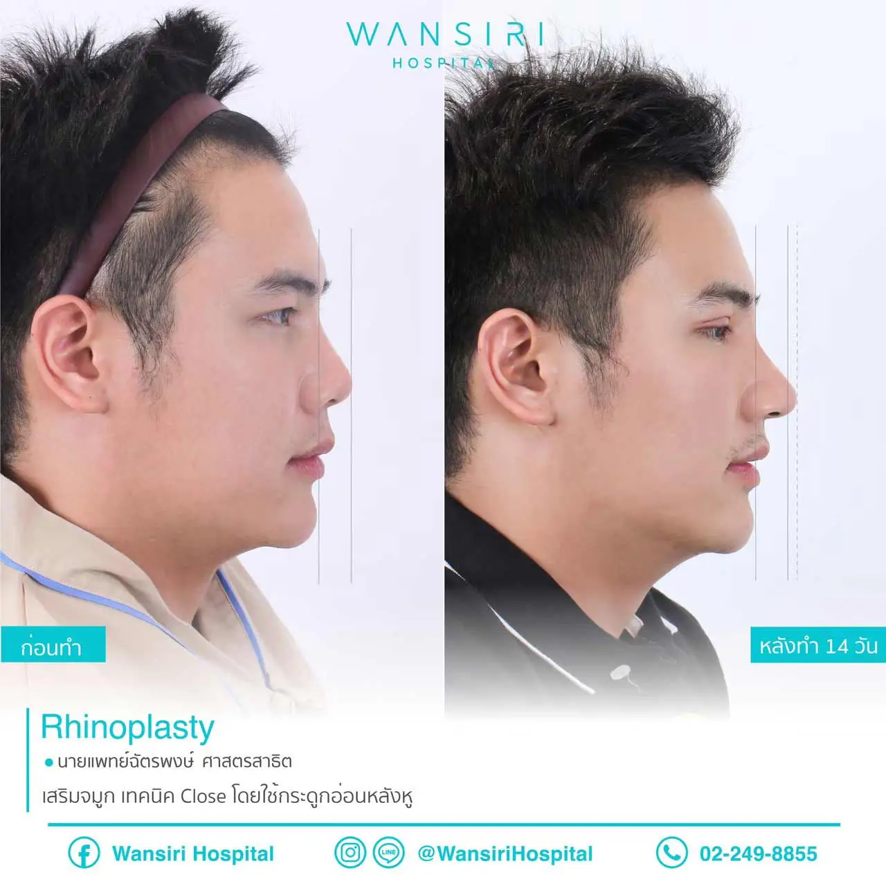 Closed Rhinoplasty in Bangkok, Thailand by Wansiri Hospital