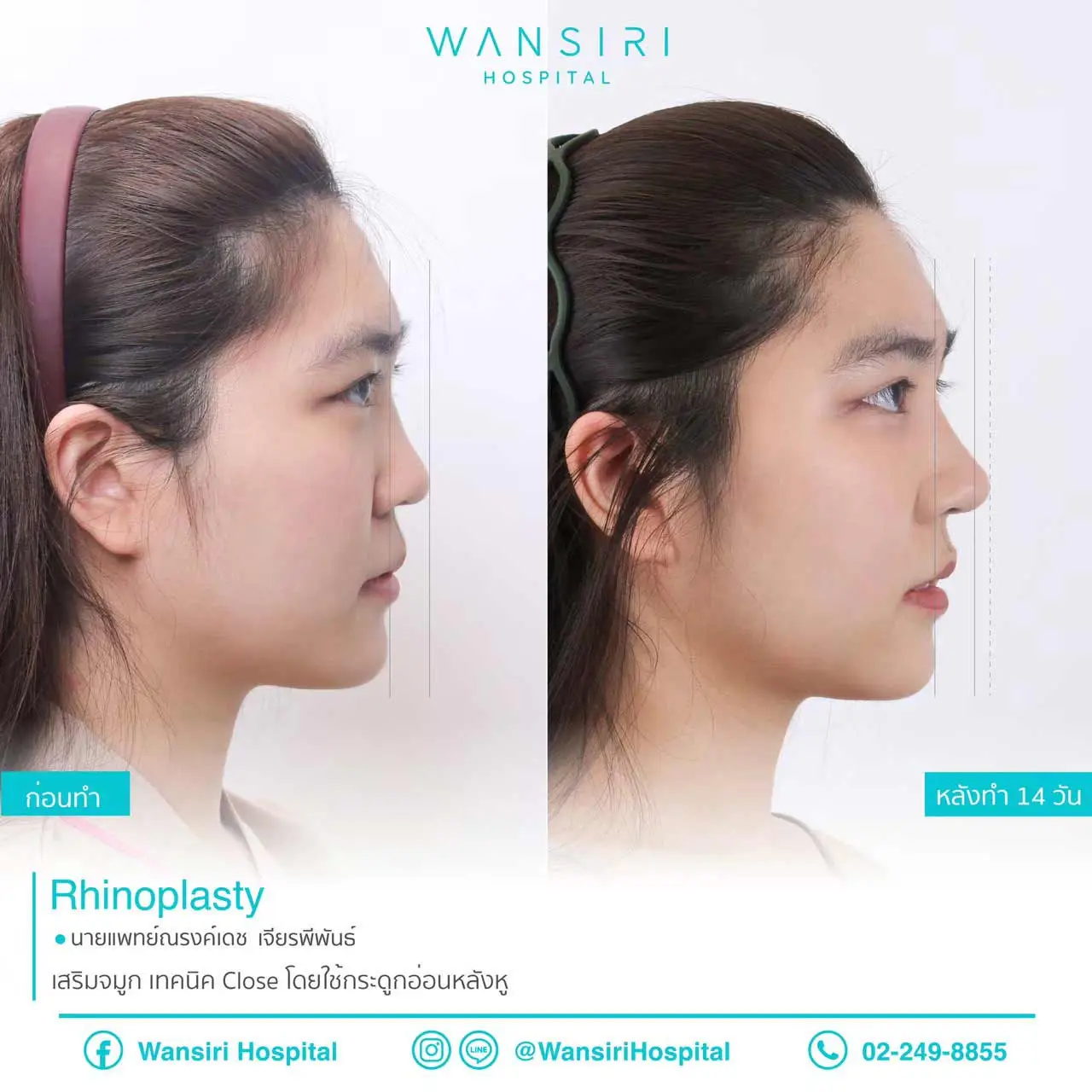 Closed Rhinoplasty in Bangkok, Thailand by Wansiri Hospital