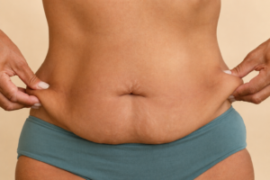 Tummy Tuck in Istanbul, Turkey by Memorial Hospital  — Plastic Surgery in Turkey