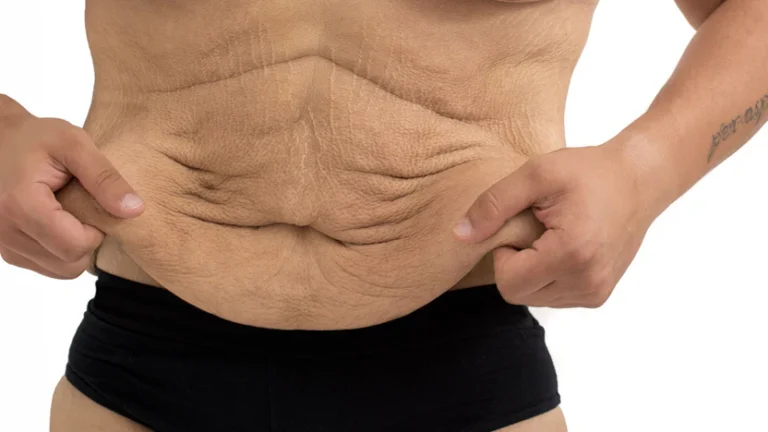 Tummy Tuck in Rio de Janeiro, Brazil by Dr. Alexandre Charão