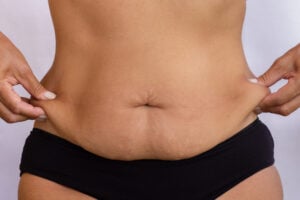 Tummy Tuck (Abdominoplasty) in Istanbul, Turkey by International Plus at International Plus — Plastic Surgery Procedure Abroad