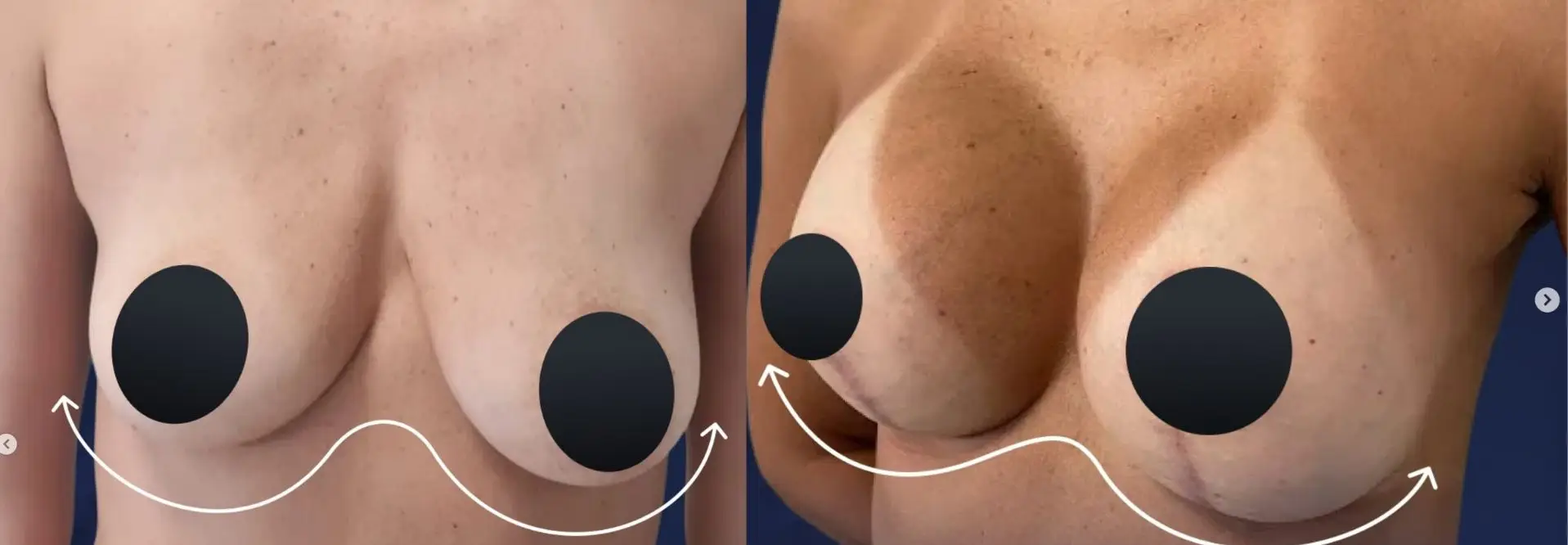 Breast Augmentation in Rio de Janeiro, Brazil by Dr. Alexandre Charão