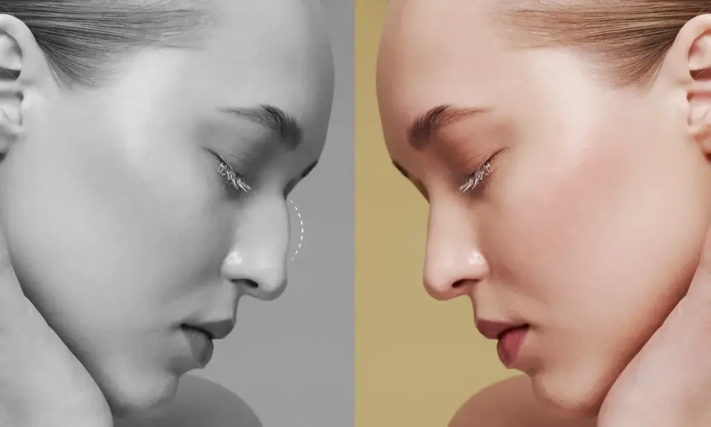 Rhinoplasty in Mexico Cost and Clinics