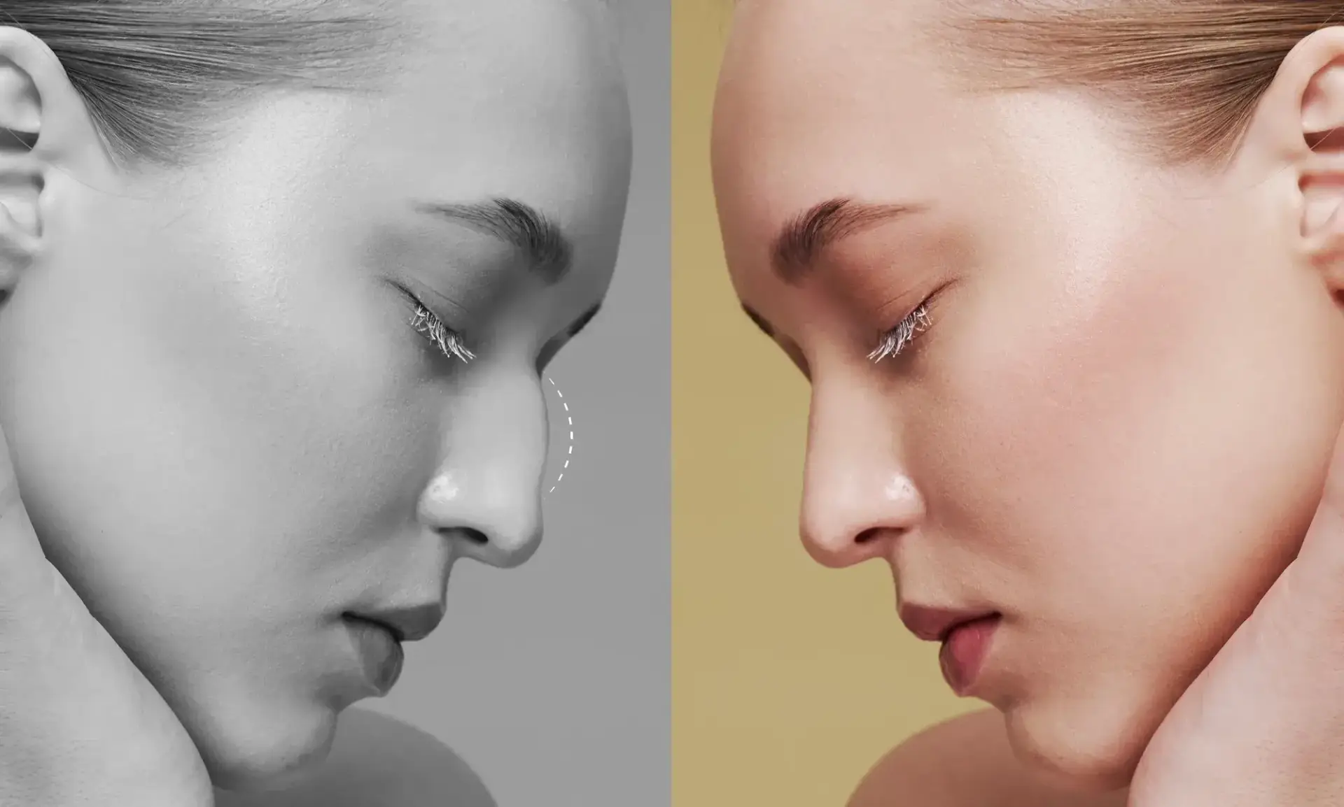 Rhinoplasty in Mexico cost