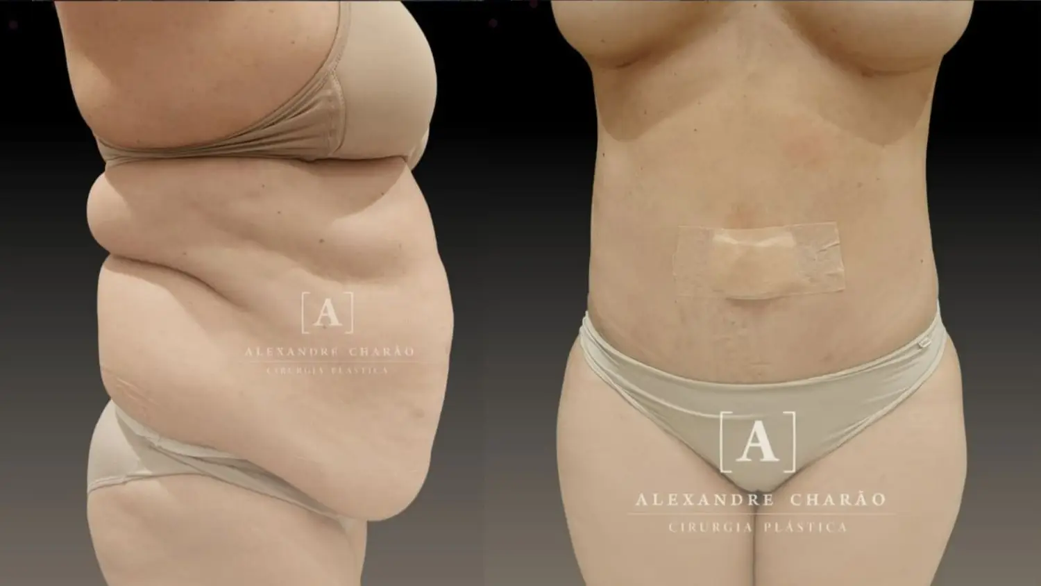 Liposuction in Rio de Janeiro, Brazil by Dr. Alexandre Charão