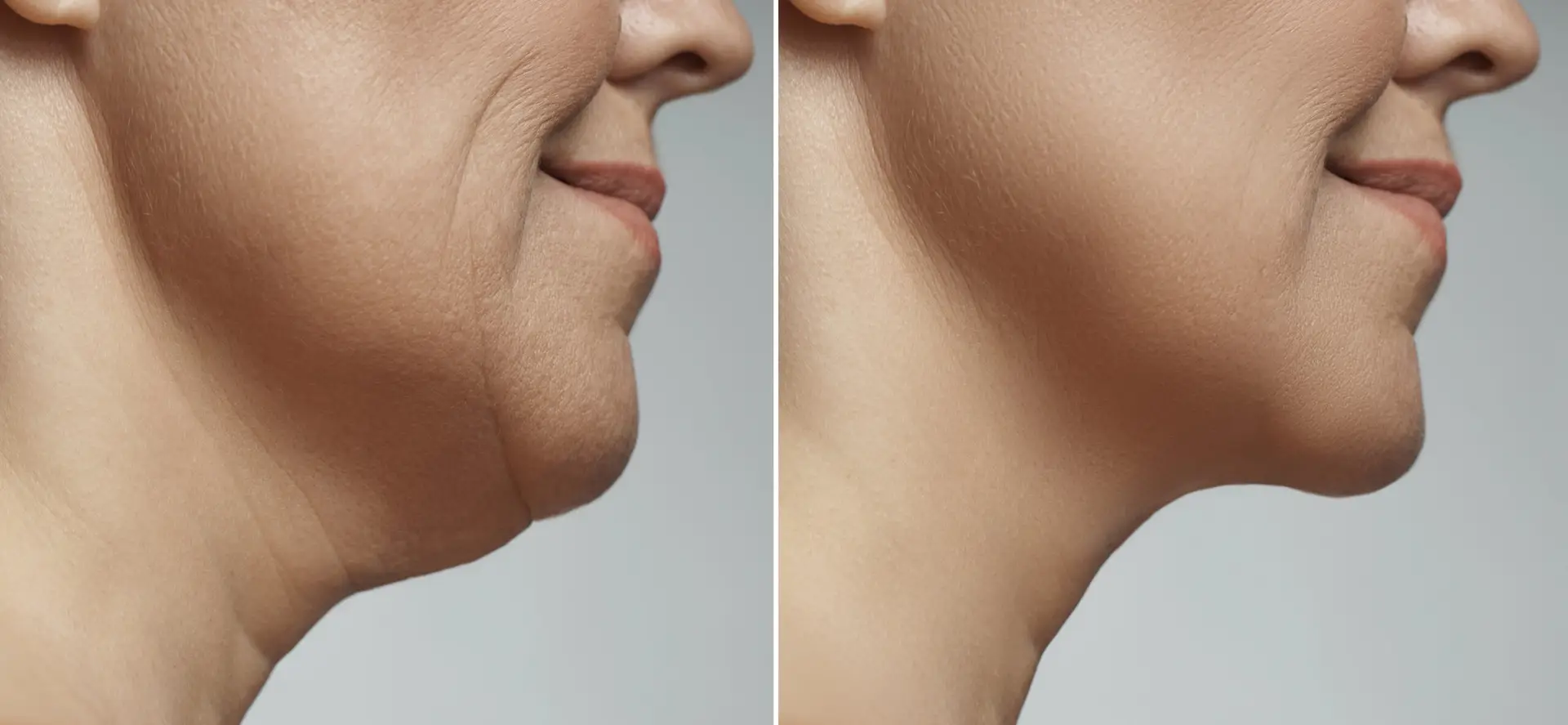 Necklift In Istanbul, Turkey by Medical Park Hospital