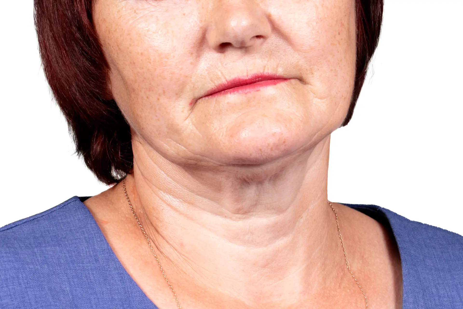Necklift In Istanbul, Turkey by Medical Park Hospital