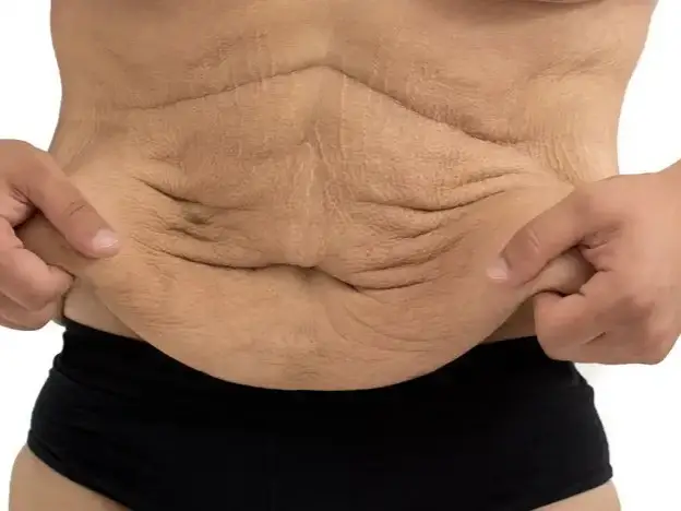 Tummy Tuck in Rio de Janeiro, Brazil by Dr. Alexandre Charão — Plastic Surgery Procedure in Brazil