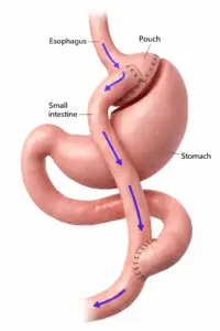 Gastric Bypass (R-YGB) in Istanbul, Turkey by Memorial Hospital