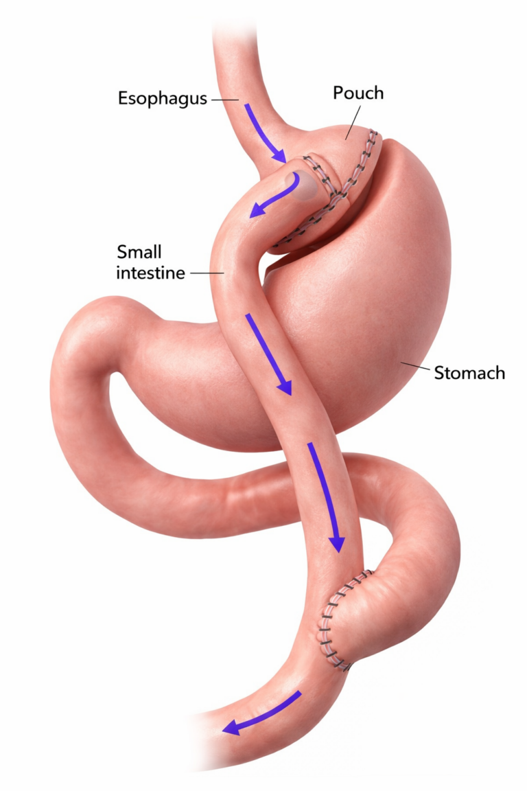 Gastric Bypass (R-YGB) in Istanbul, Turkey by Memorial Hospital