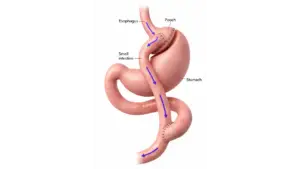 Gastric Bypass Surgery in Istanbul, Turkey by Avicenna Hospital