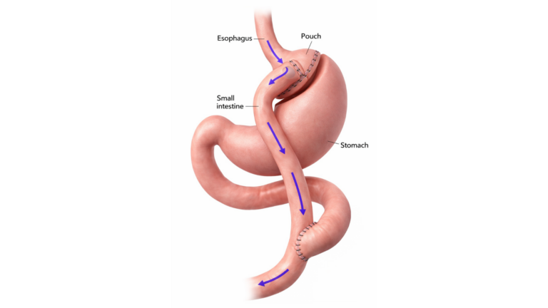 Gastric Bypass Surgery in Istanbul, Turkey by Avicenna Hospital
