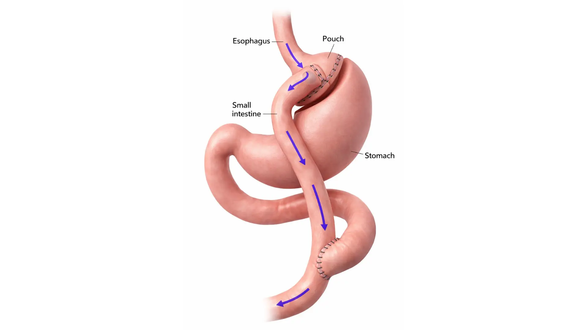 Gastric Bypass Surgery in Playa del Carmen, Mexico by CostaMed Medical Group