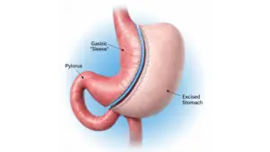 Gastric Sleeve Surgery in Istanbul, Turkey by Avicenna Hospital