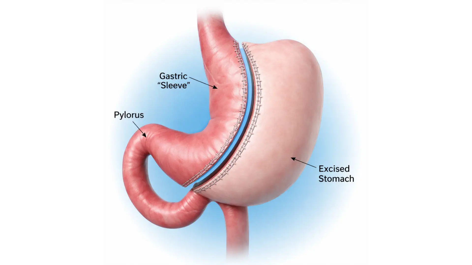 Gastric Sleeve Surgery in Playa del Carmen, Mexico by CostaMed Medical Group — Procedure Gallery Photo