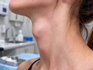 Tracheal Shave (Adam’s Apple Reduction) in Bangkok, Thailand by Wansiri Hospital — Plastic Surgery in Thailand