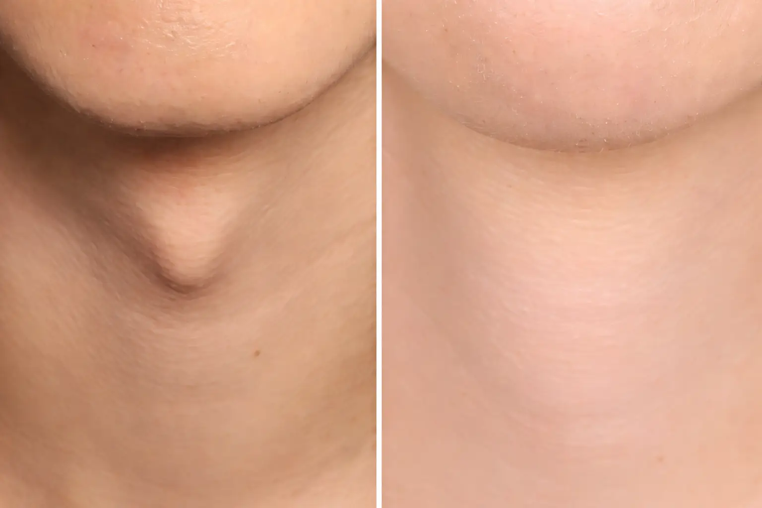 Tracheal Shave (Adam’s Apple Reduction) in Bangkok, Thailand by Wansiri Hospital
