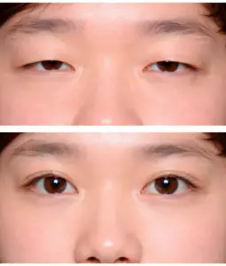 Blepharoplasty in Bangkok, Thailand by Wansiri Hospital