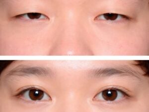 Blepharoplasty in Bangkok, Thailand by Wansiri Hospital — Plastic Surgery in Thailand