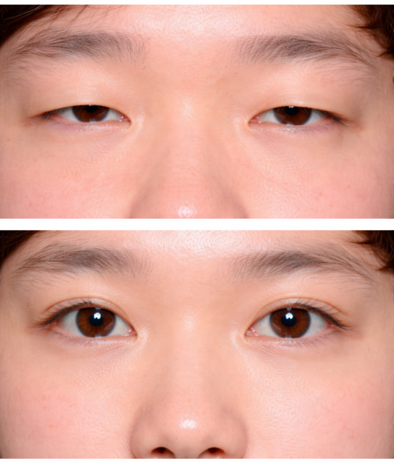 Blepharoplasty in Bangkok, Thailand by Wansiri Hospital