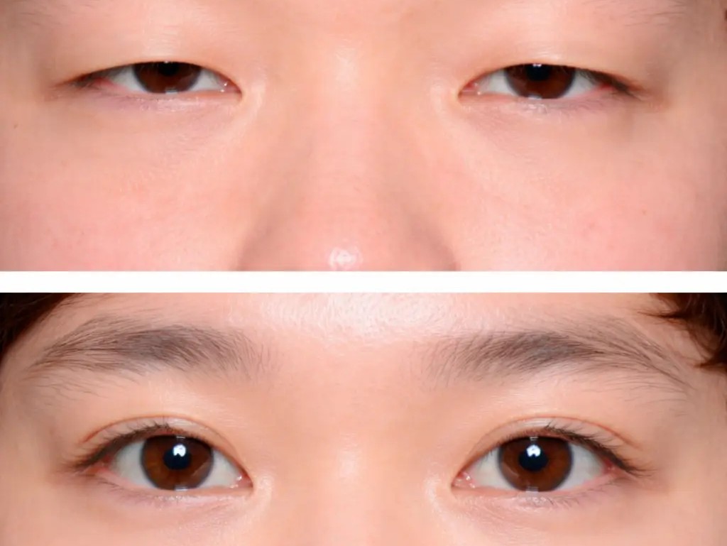 Blepharoplasty in Bangkok, Thailand by Wansiri Hospital — Plastic Surgery Procedure in Thailand