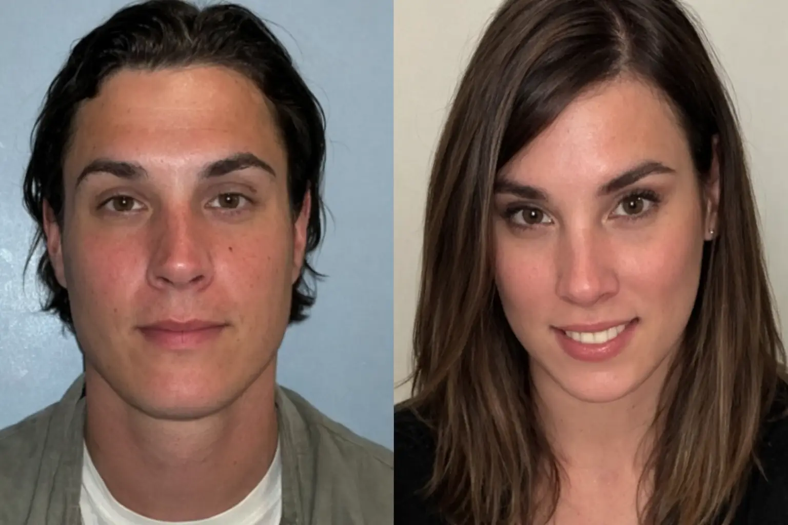 Facial Feminization Surgery (FFS) in Bangkok, Thailand by Wansiri Hospital
