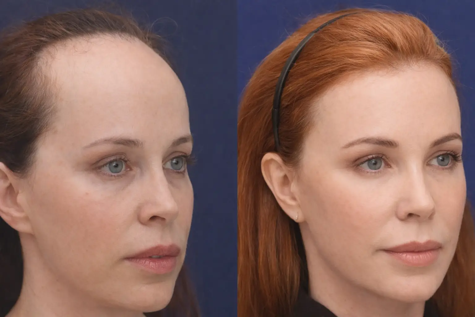 Forehead Reduction in Bangkok, Thailand by Wansiri Hospital