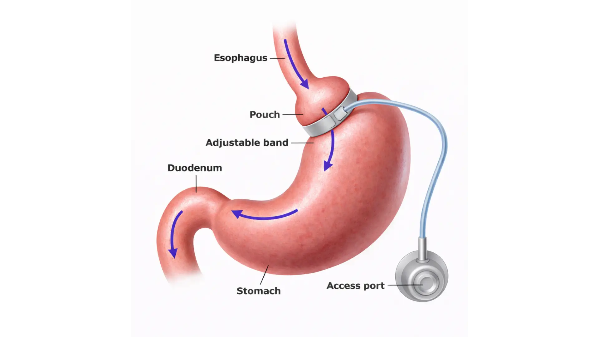 Gastric Band Surgery in Playa del Carmen, Mexico by CostaMed Medical Group — Procedure Gallery Photo