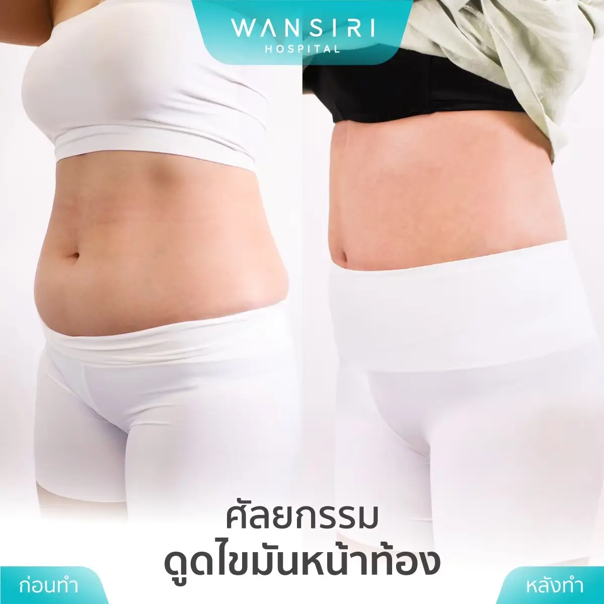 Liposuction in Bangkok, Thailand by Wansiri Hospital