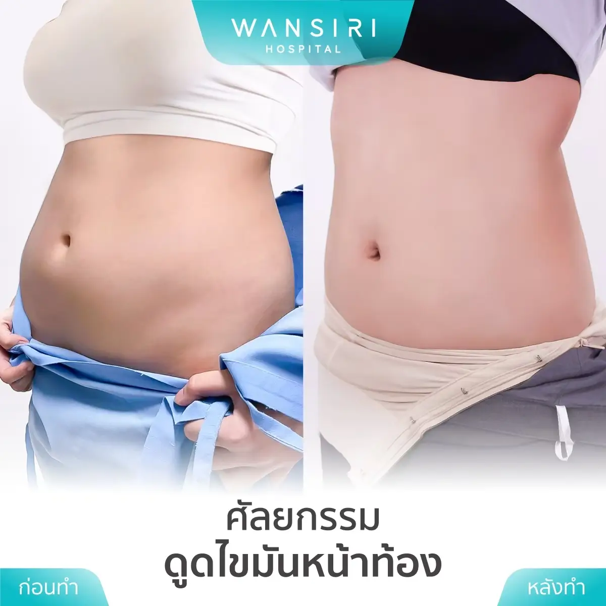 Liposuction in Bangkok, Thailand by Wansiri Hospital