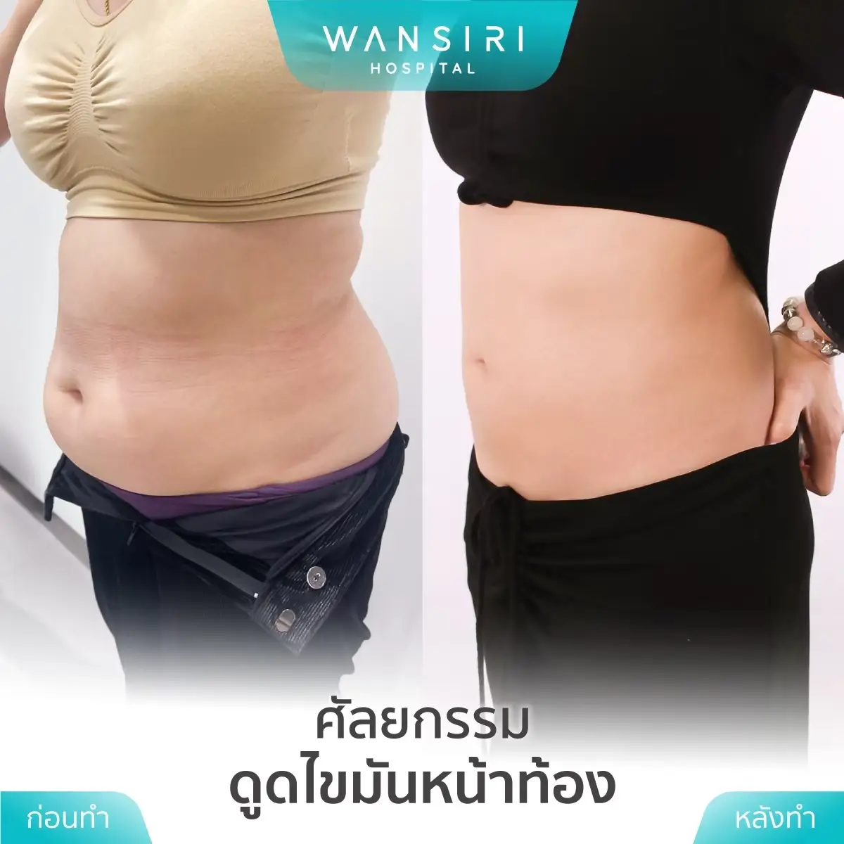 Liposuction in Bangkok, Thailand by Wansiri Hospital