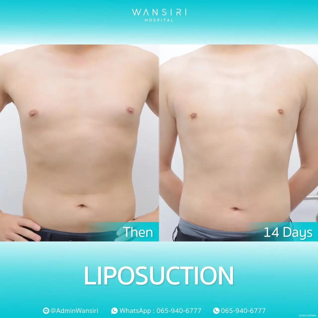 Liposuction in Bangkok, Thailand by Wansiri Hospital