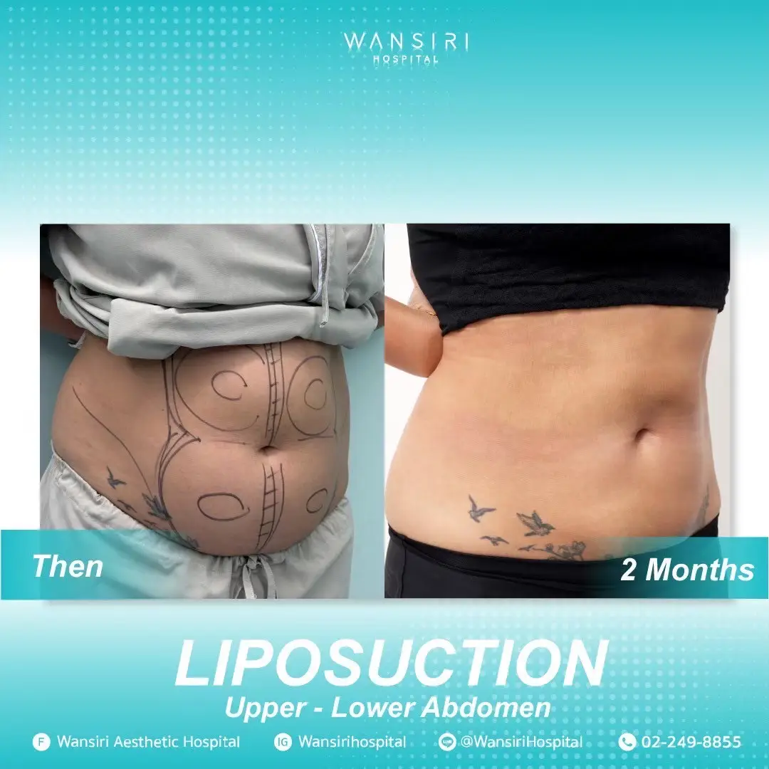 Liposuction in Bangkok, Thailand by Wansiri Hospital