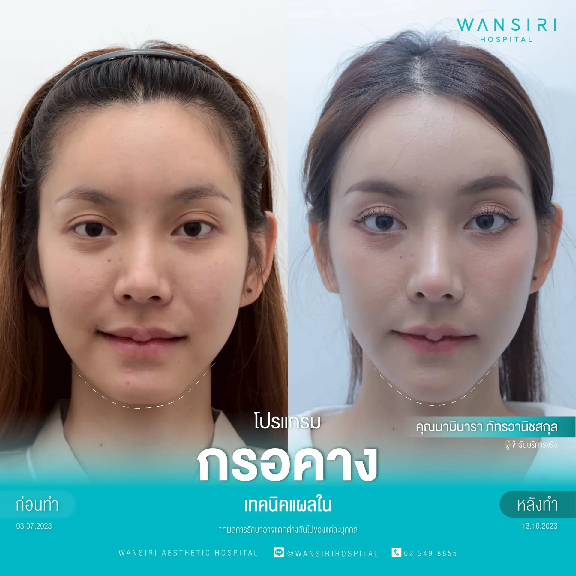 Chin Reduction (Mentoplasty) in Bangkok, Thailand by Wansiri Hospital