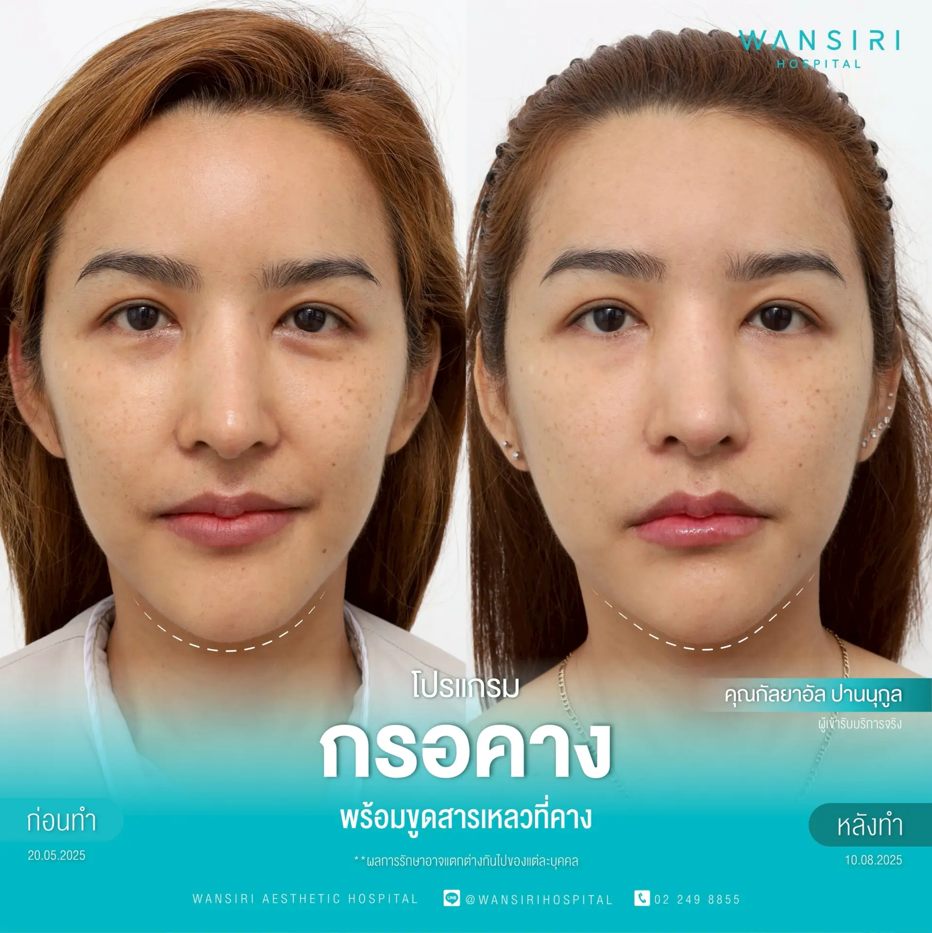 Chin Reduction (Mentoplasty) in Bangkok, Thailand by Wansiri Hospital