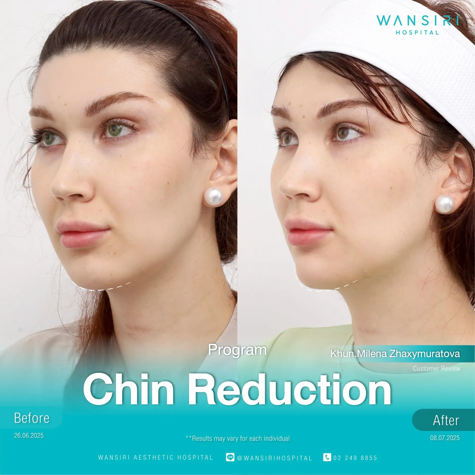 Chin Reduction (Mentoplasty) in Bangkok, Thailand by Wansiri Hospital