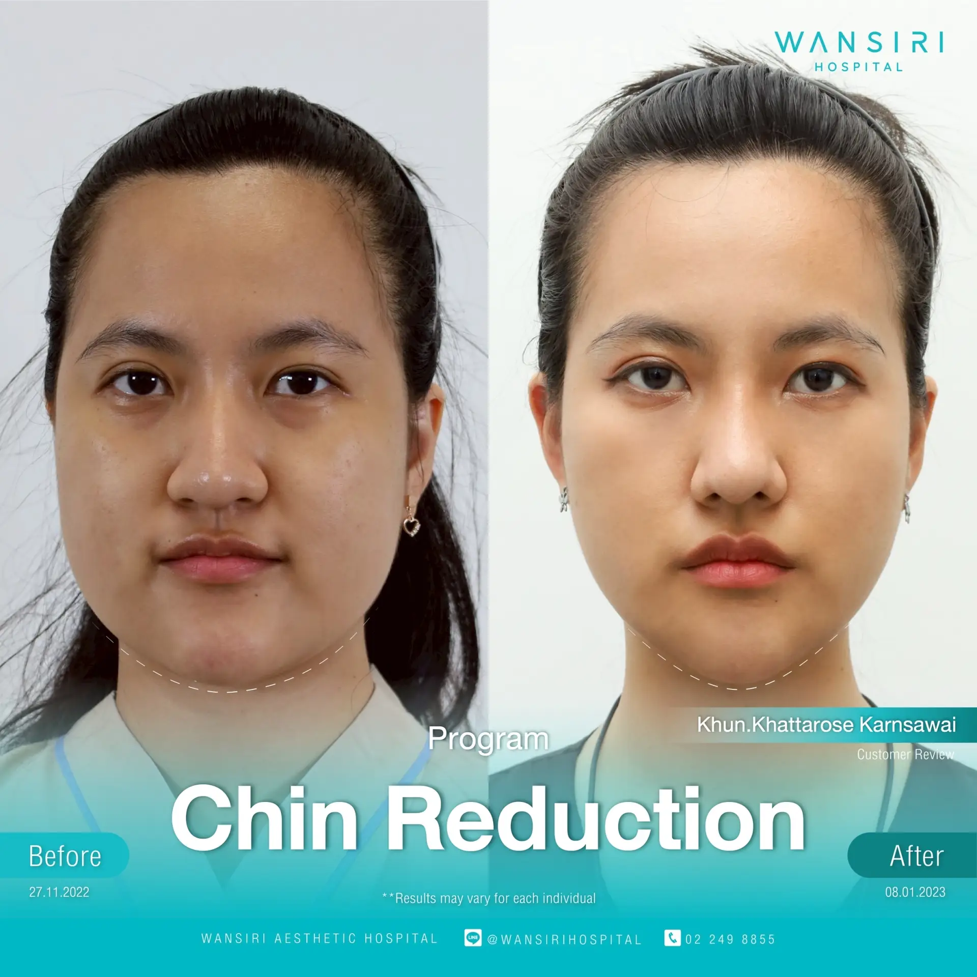Chin Reduction (Mentoplasty) in Bangkok, Thailand by Wansiri Hospital