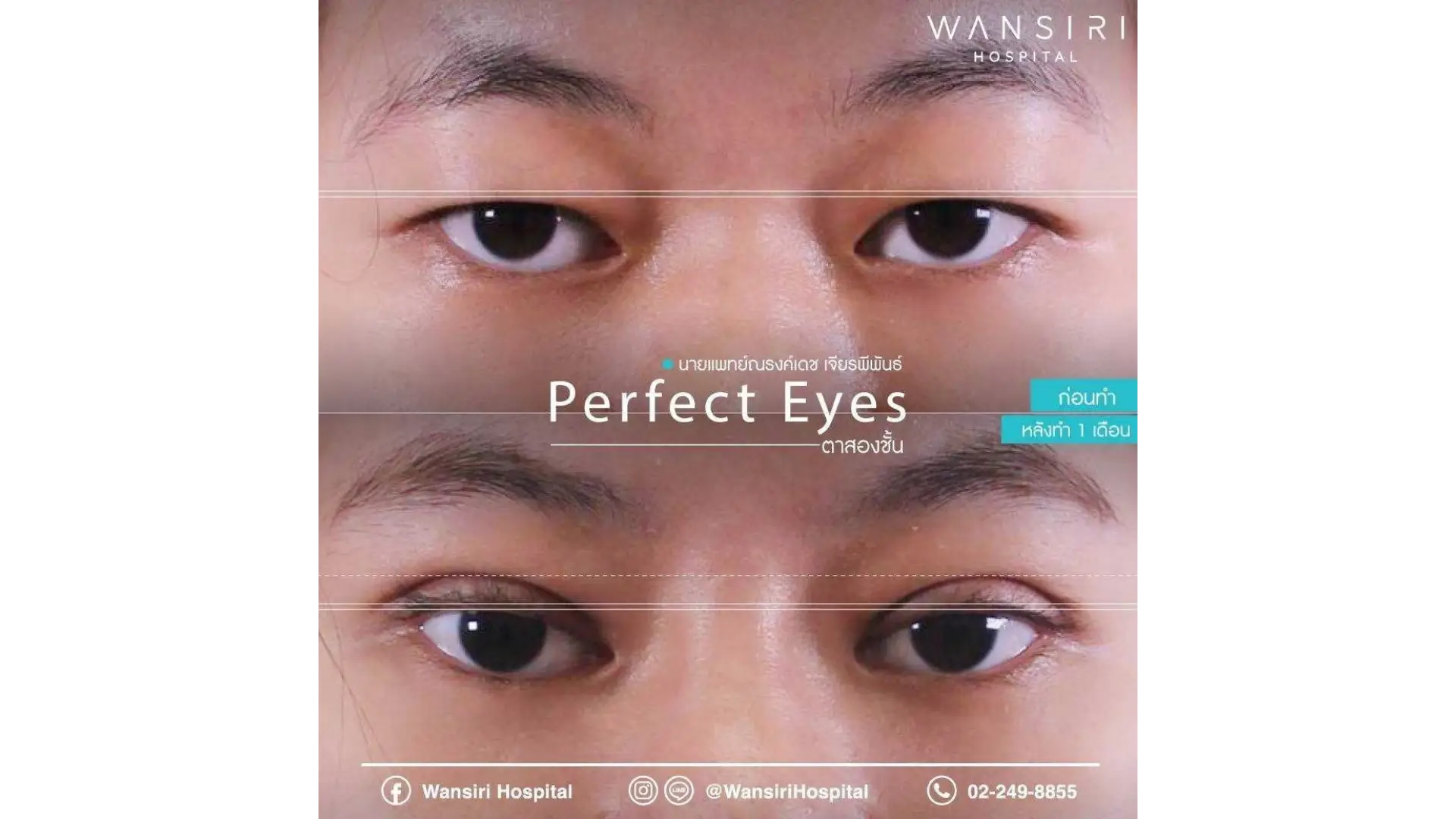 Epicanthoplasty in Bangkok, Thailand by Wansiri Hospital