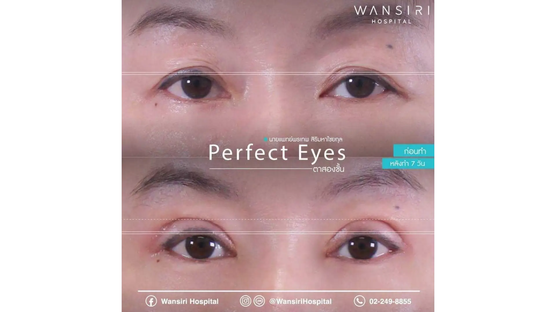 Blepharoplasty in Bangkok, Thailand by Wansiri Hospital