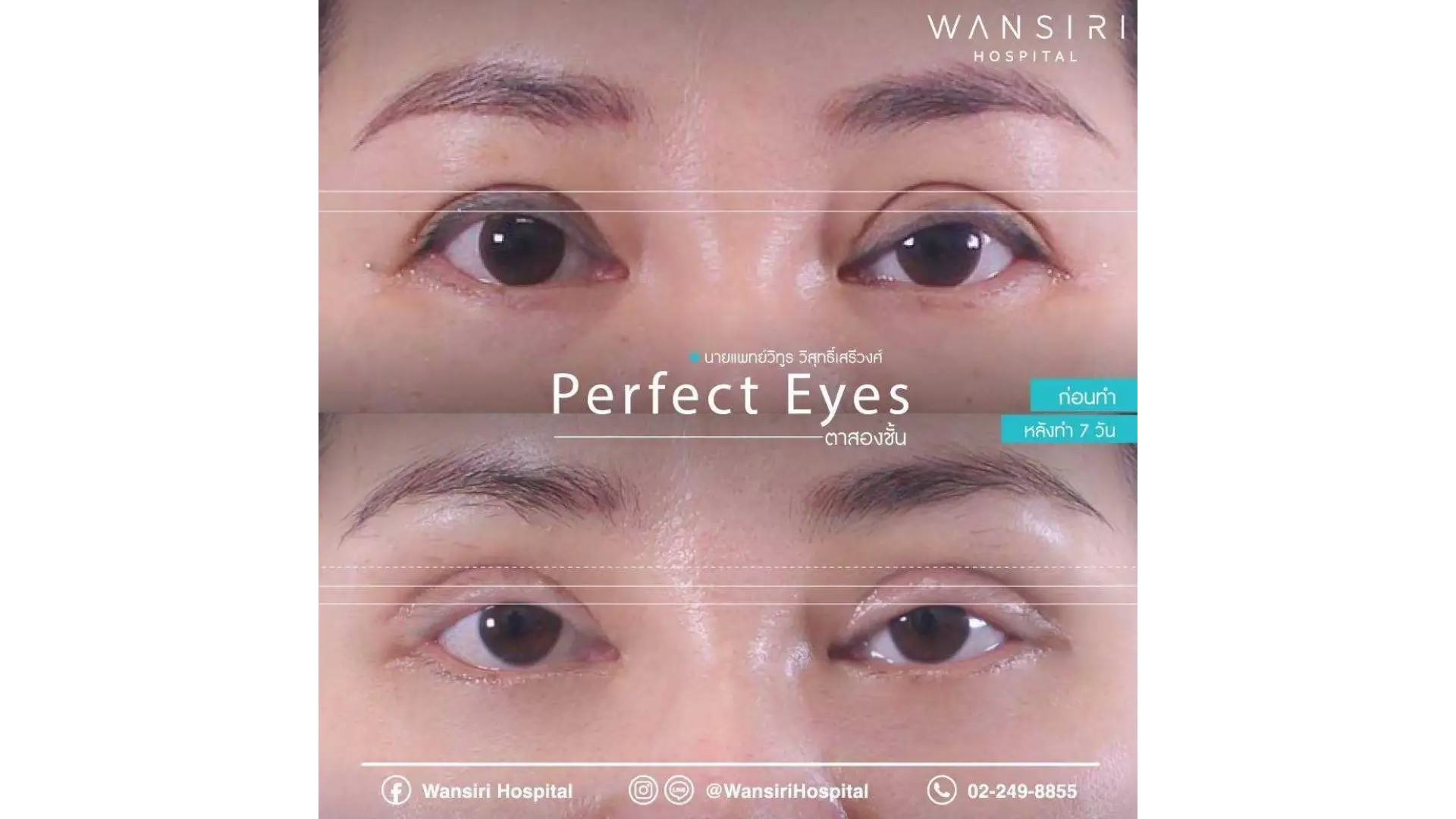 Blepharoplasty in Bangkok, Thailand by Wansiri Hospital