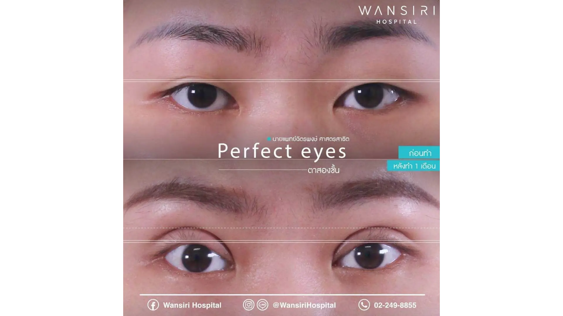 Blepharoplasty in Bangkok, Thailand by Wansiri Hospital