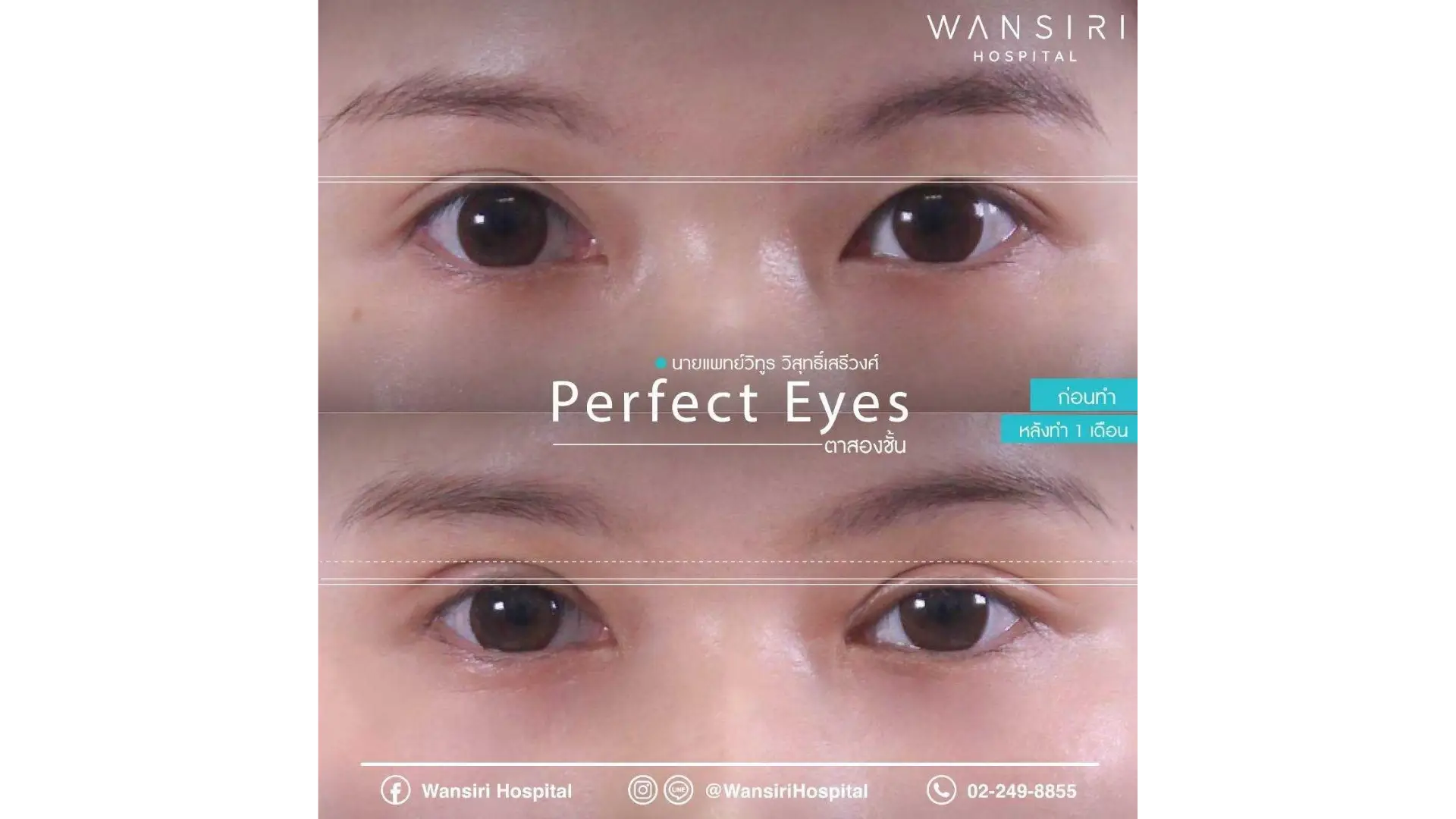 Blepharoplasty in Bangkok, Thailand by Wansiri Hospital